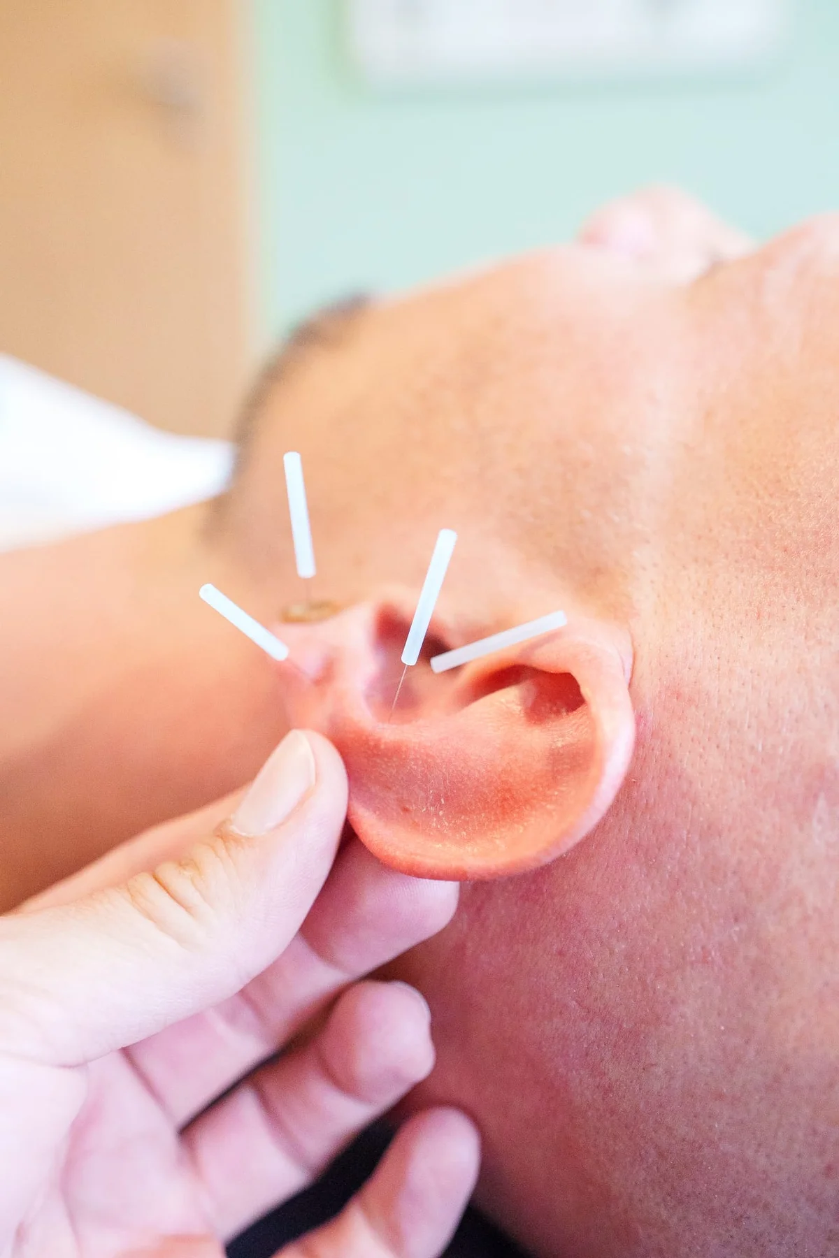 Ohrakupunktur mit sterilen Einmalnadeln in der Naturheilpraxis